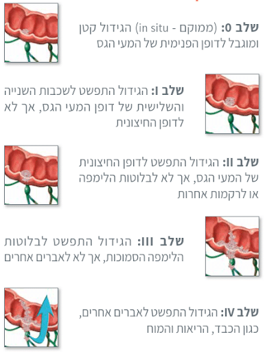 שלבי מחלת סרטן המעי הגס - אונקוטסט