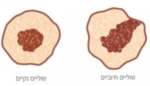 שוליים חיוביים ושוליים נקיים של תאים סרטניים - אונקוטסט