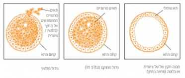 סרטן שד לא פולשני אונקוטסט, טיפול מותאם אישית בסרטן השד
